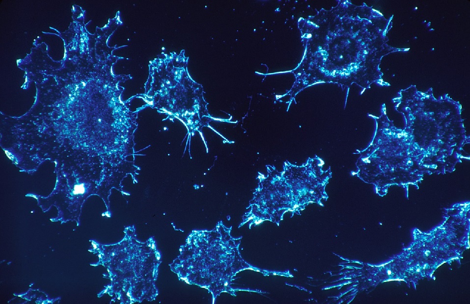 Nuevo tratamiento experimental destruye células cancerígenas sin necesidad de usar medicamentos