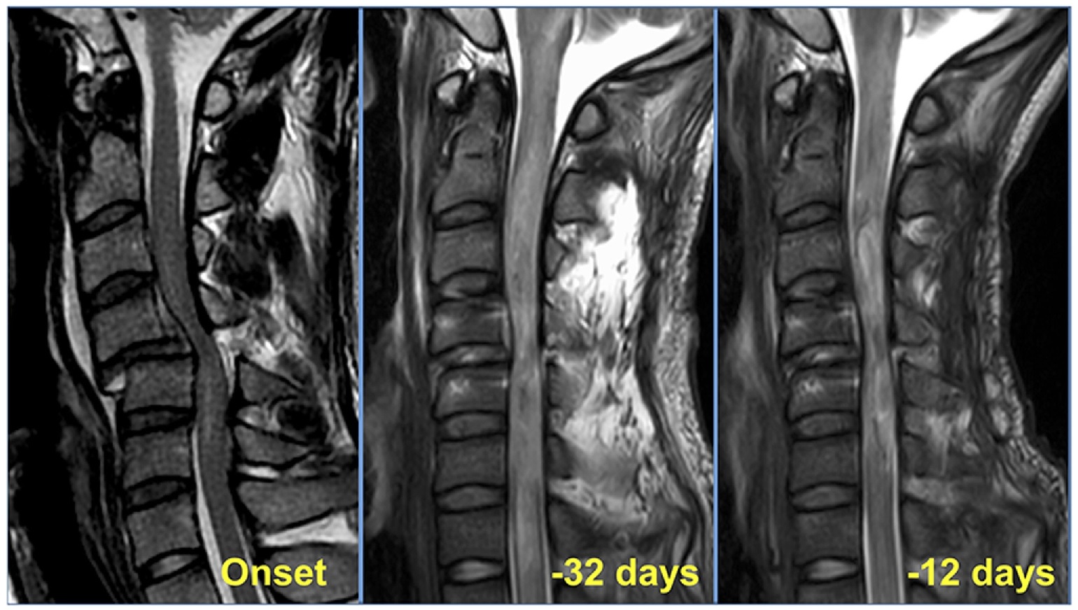 Nueva terapia con células madre ayudó a reparar la médula espinal lesionada de 13 pacientes
