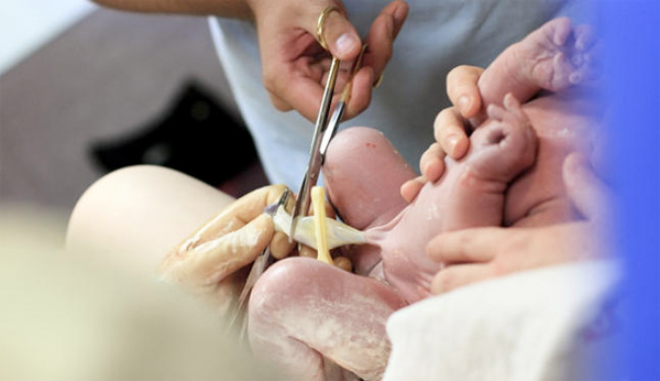 Esperar 60 segundos para cortar el cordón umbilical tiene efectos significativos en bebés prematuros