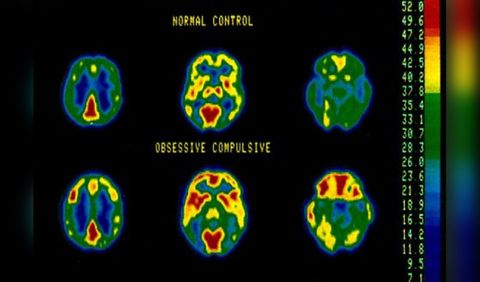 Científicos identifican detalladamente las señales cerebrales asociadas con el TOC