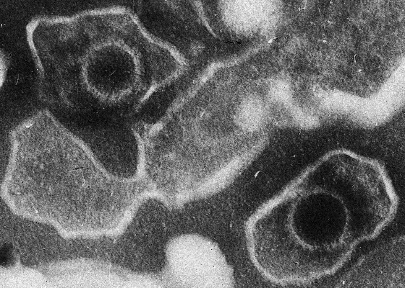 Un tratamiento contra un virus común podría actuar también contra la esclerosis múltiple