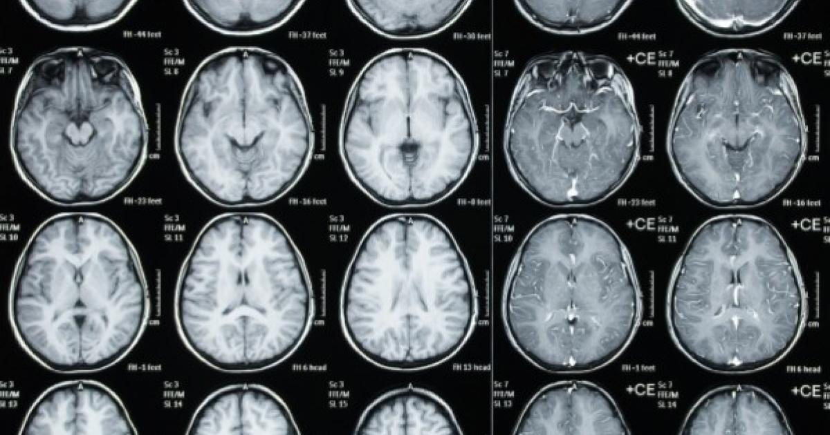 BrainChart: la base de datos más completa del cerebro humano creada con más de 100 mil resonancias magnéticas