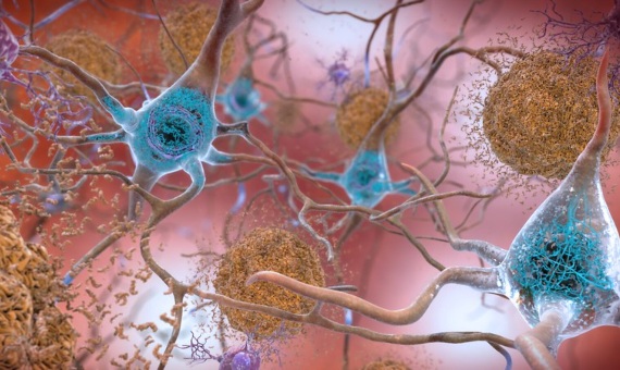 Hallan más evidencia de cómo dos virus se unen para causar Alzheimer