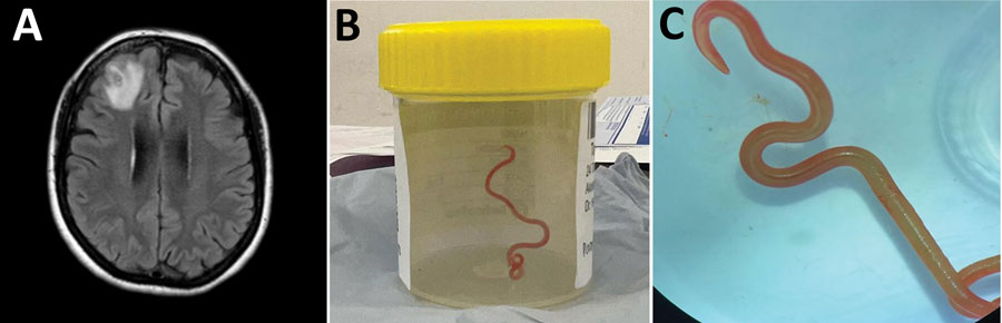 Neurocirujanos encontraron un gusano adulto vivo en el cerebro de una mujer