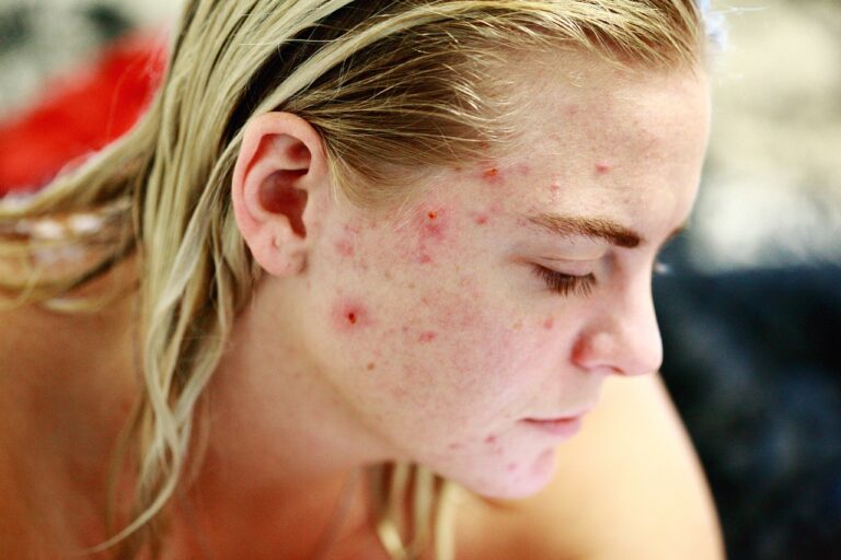 ¿Sufres de acné? Científicos farmacéuticos podrían haber encontrado una solución