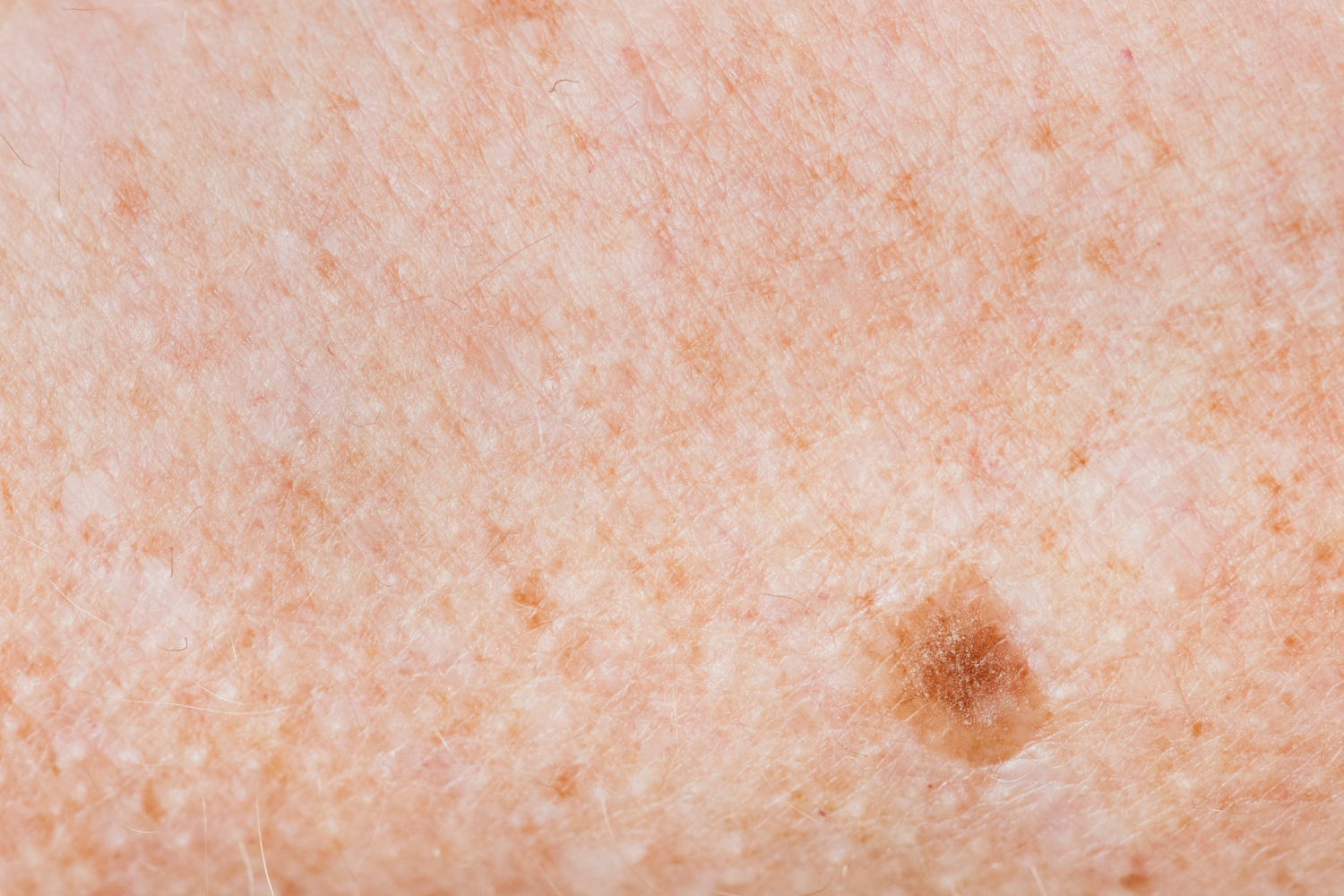 Ensayo clínico demuestra la efectividad de una vacuna contra el cáncer de piel